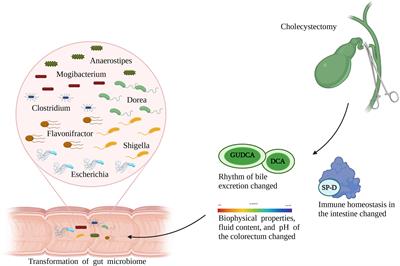 Progress in the Study of Colorectal Cancer Caused by Altered Gut Microbiota After Cholecystectomy